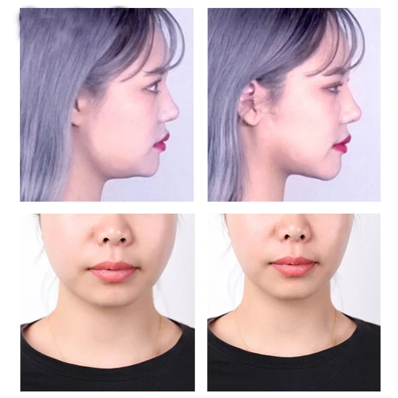 Supplier before and after side and front photos of a jawline